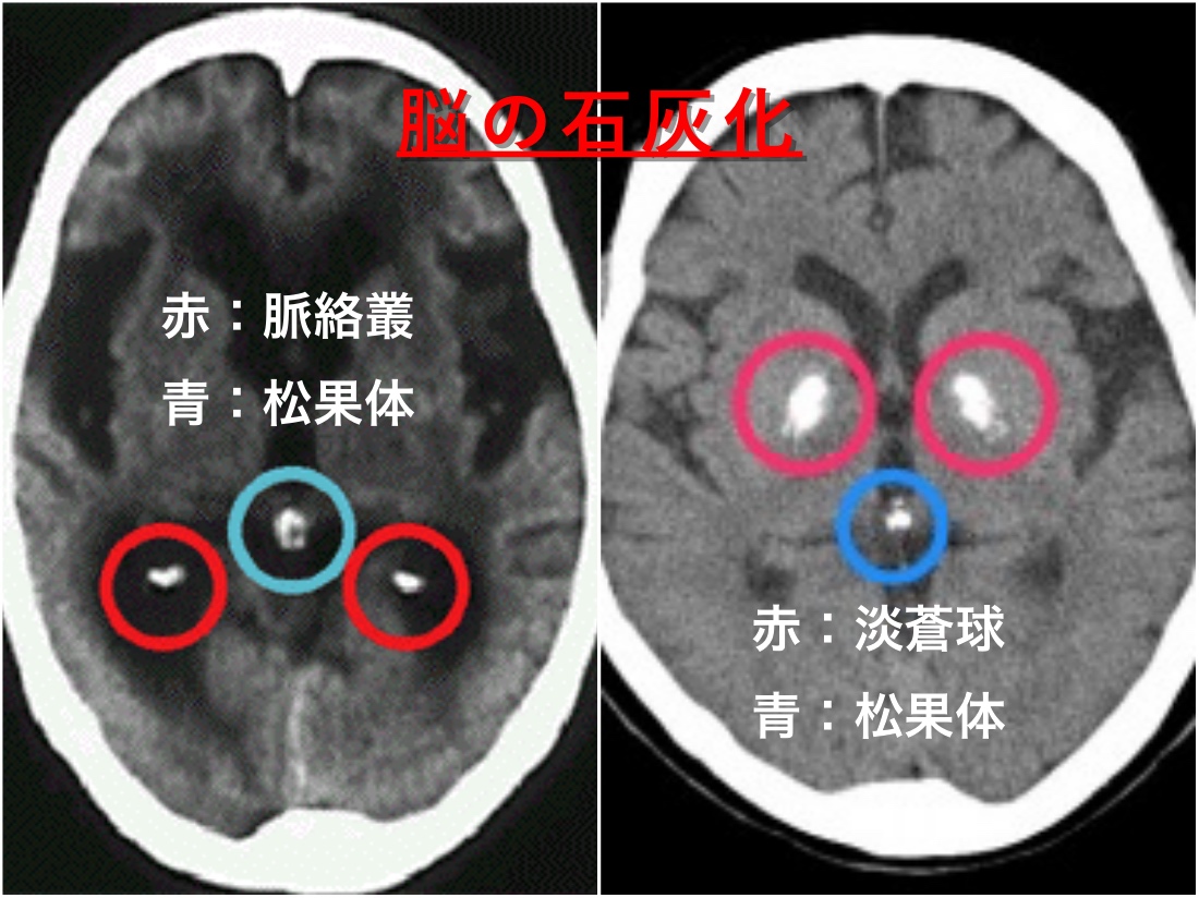 脈絡叢と松果体の石灰化CT写真